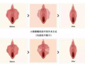 做了私密整形,重塑自信之美
